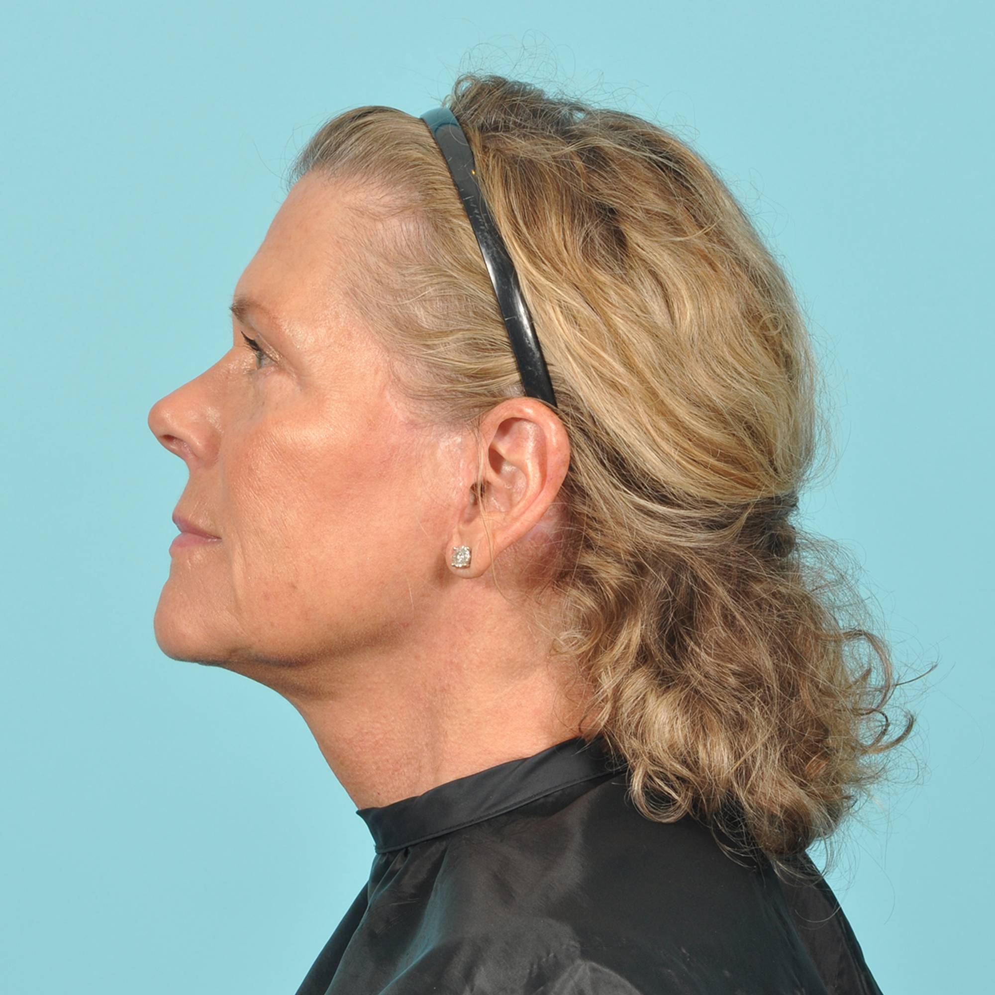 Blepharoplasty Before & After Image