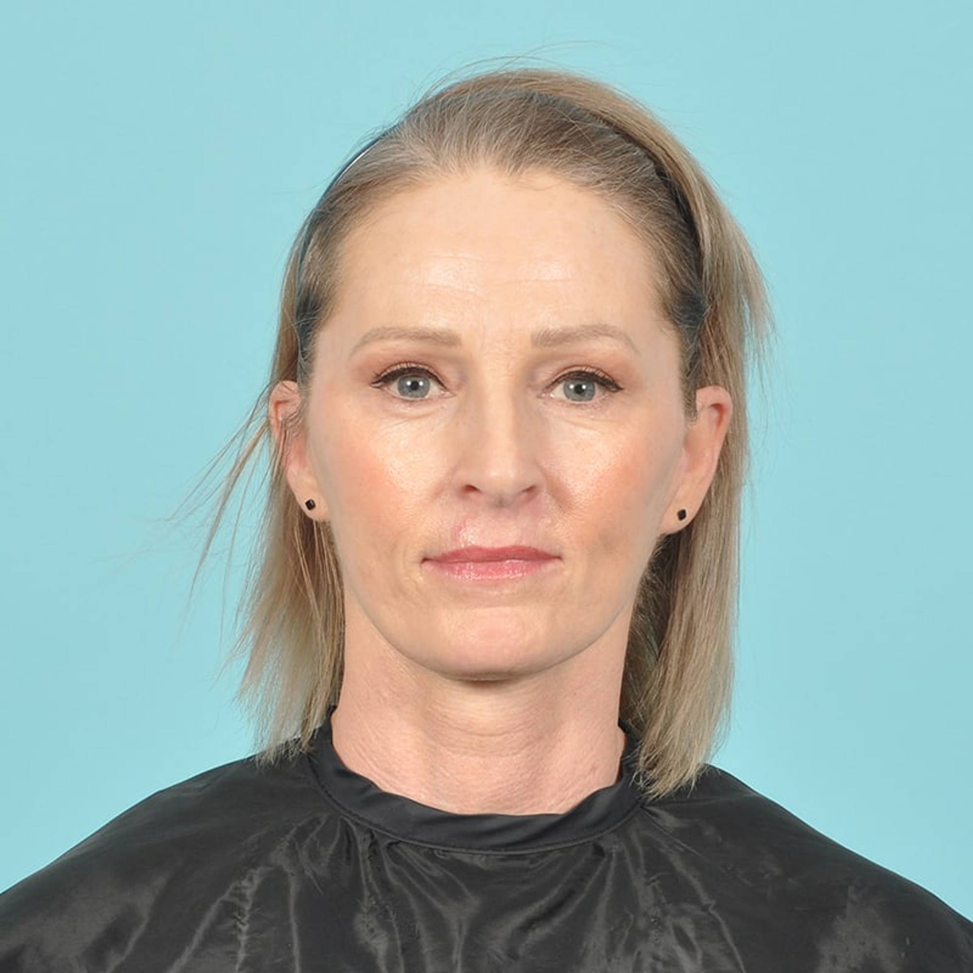 Blepharoplasty Before & After Image