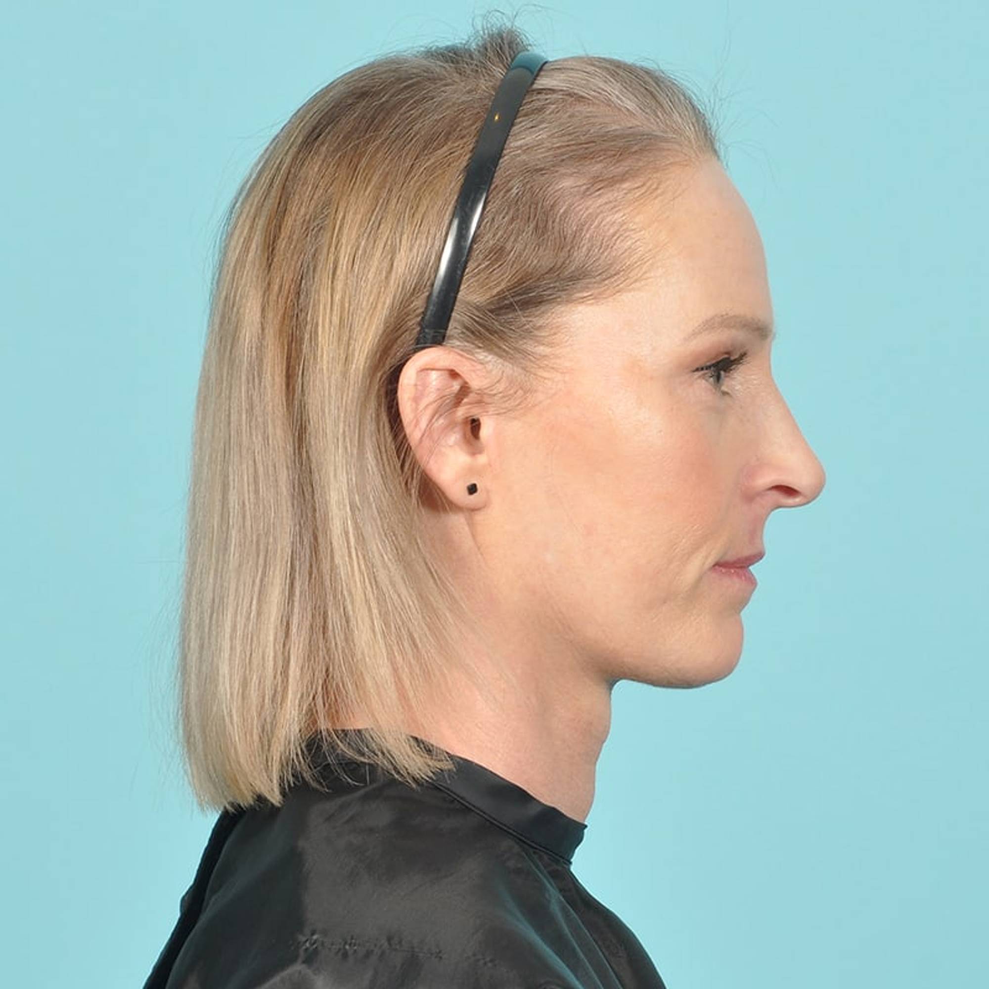 Blepharoplasty Before & After Image