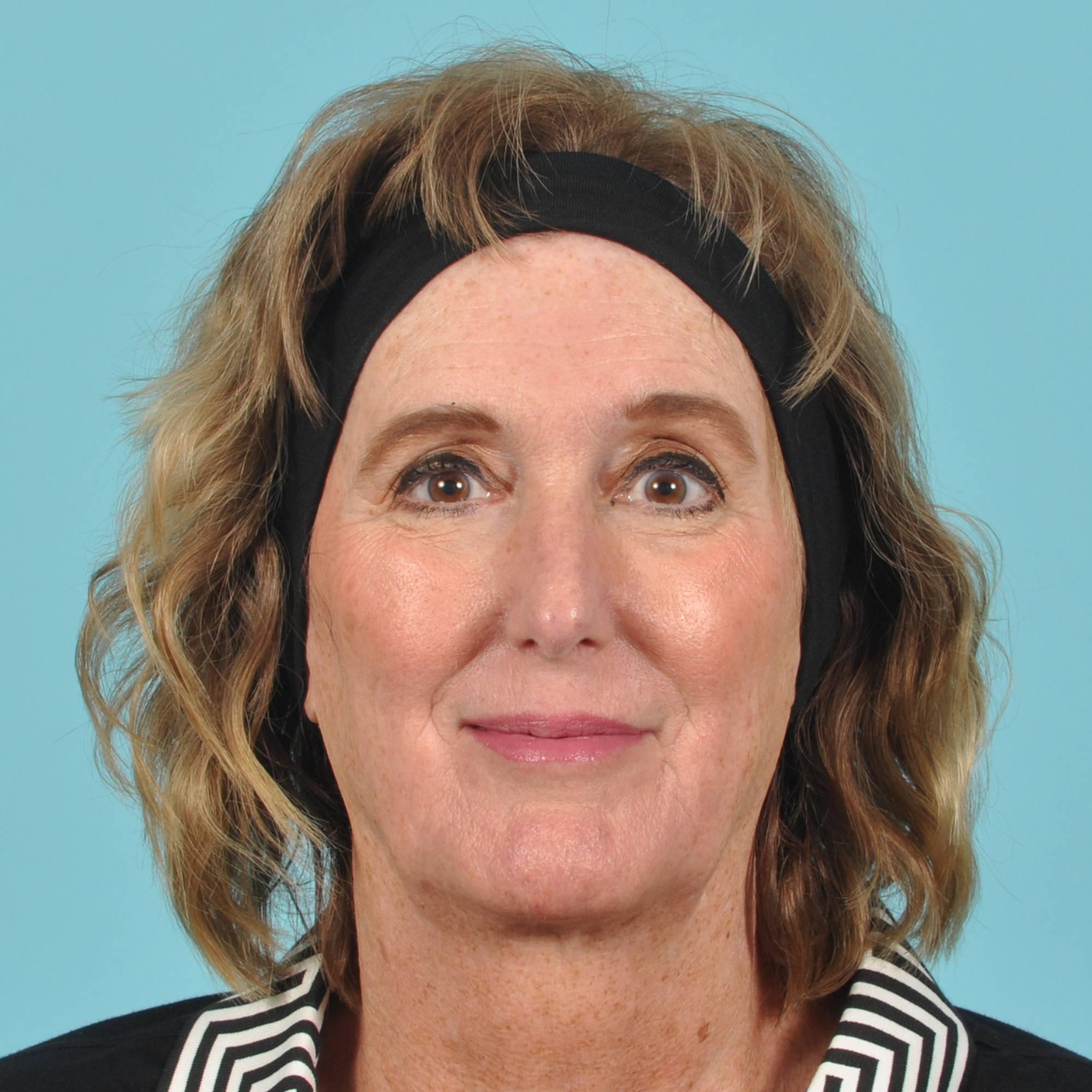 Blepharoplasty Before & After Image