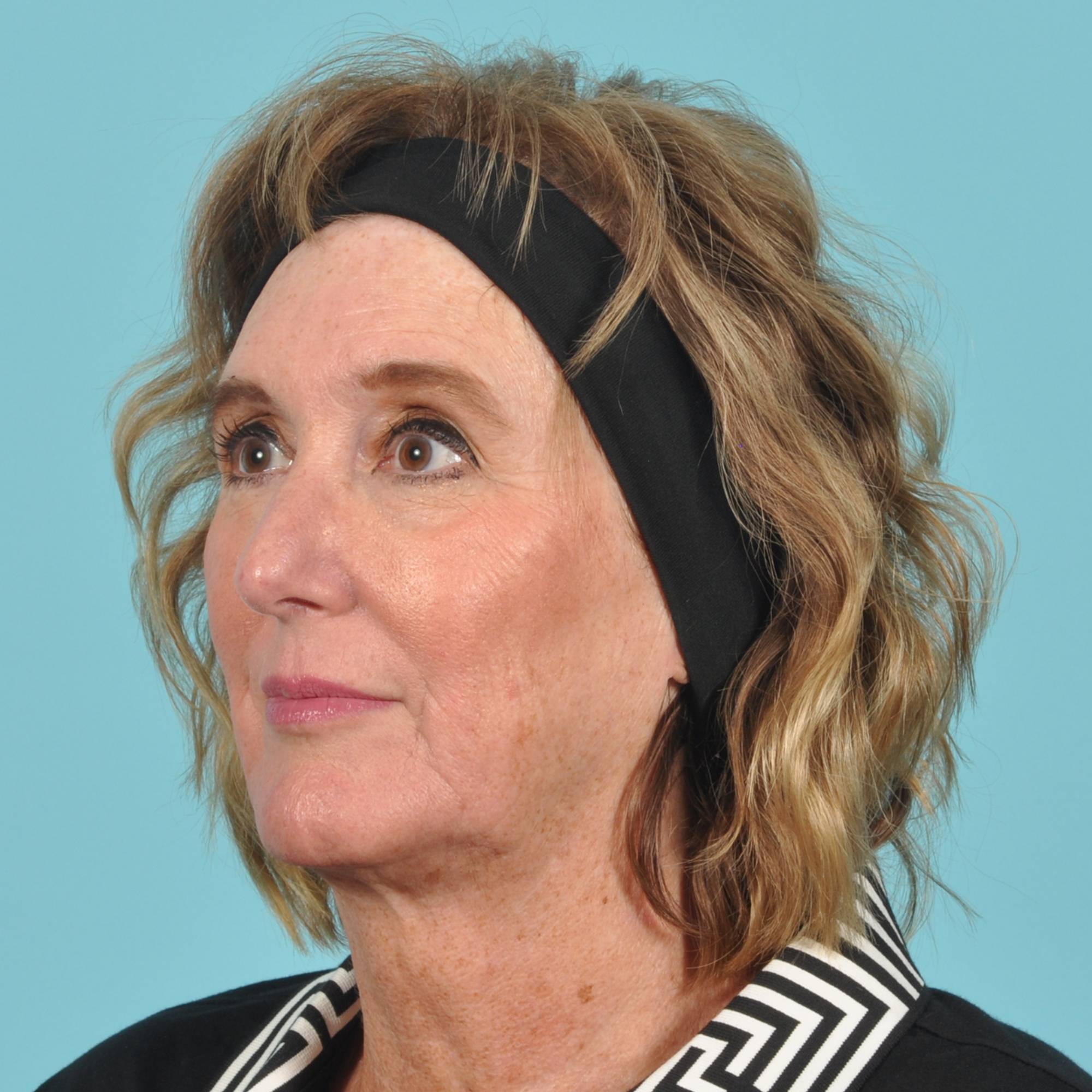 Blepharoplasty Before & After Image