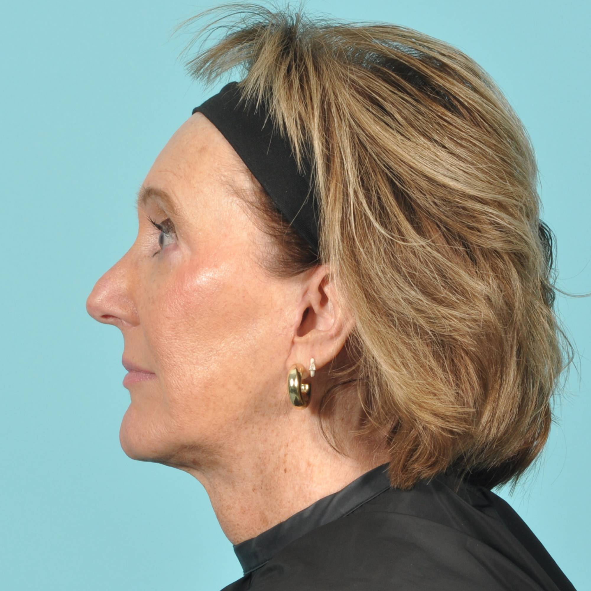 Blepharoplasty Before & After Image