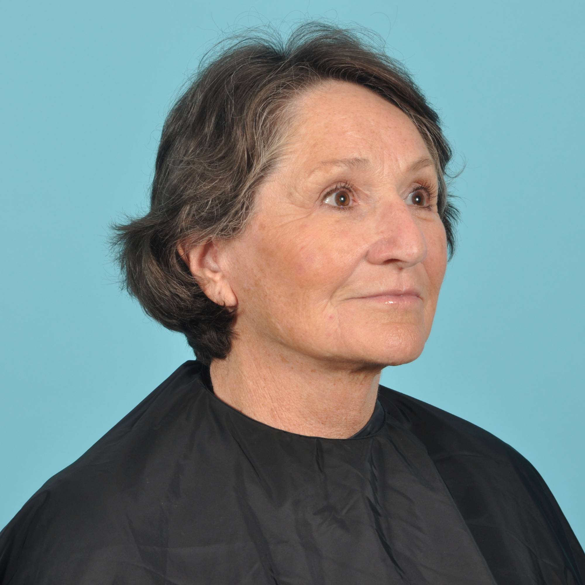 Blepharoplasty Before & After Image