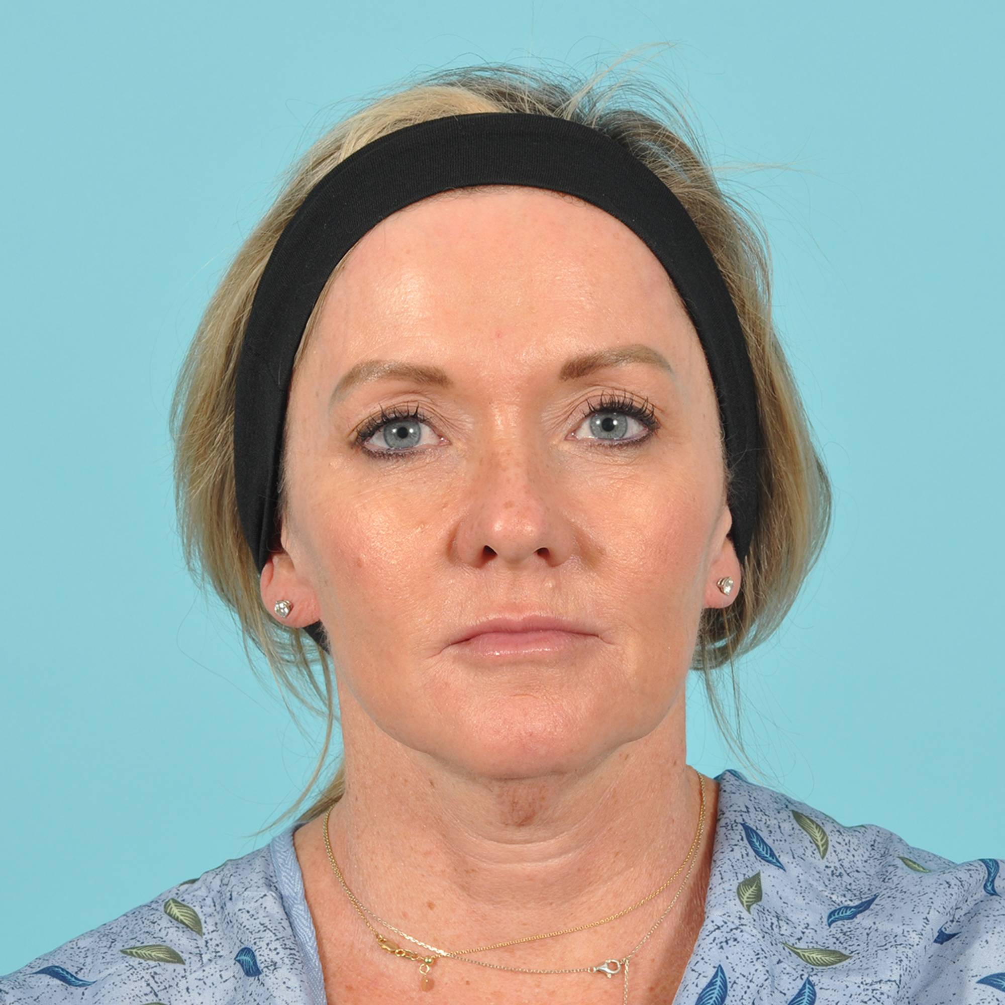 Blepharoplasty Before & After Image