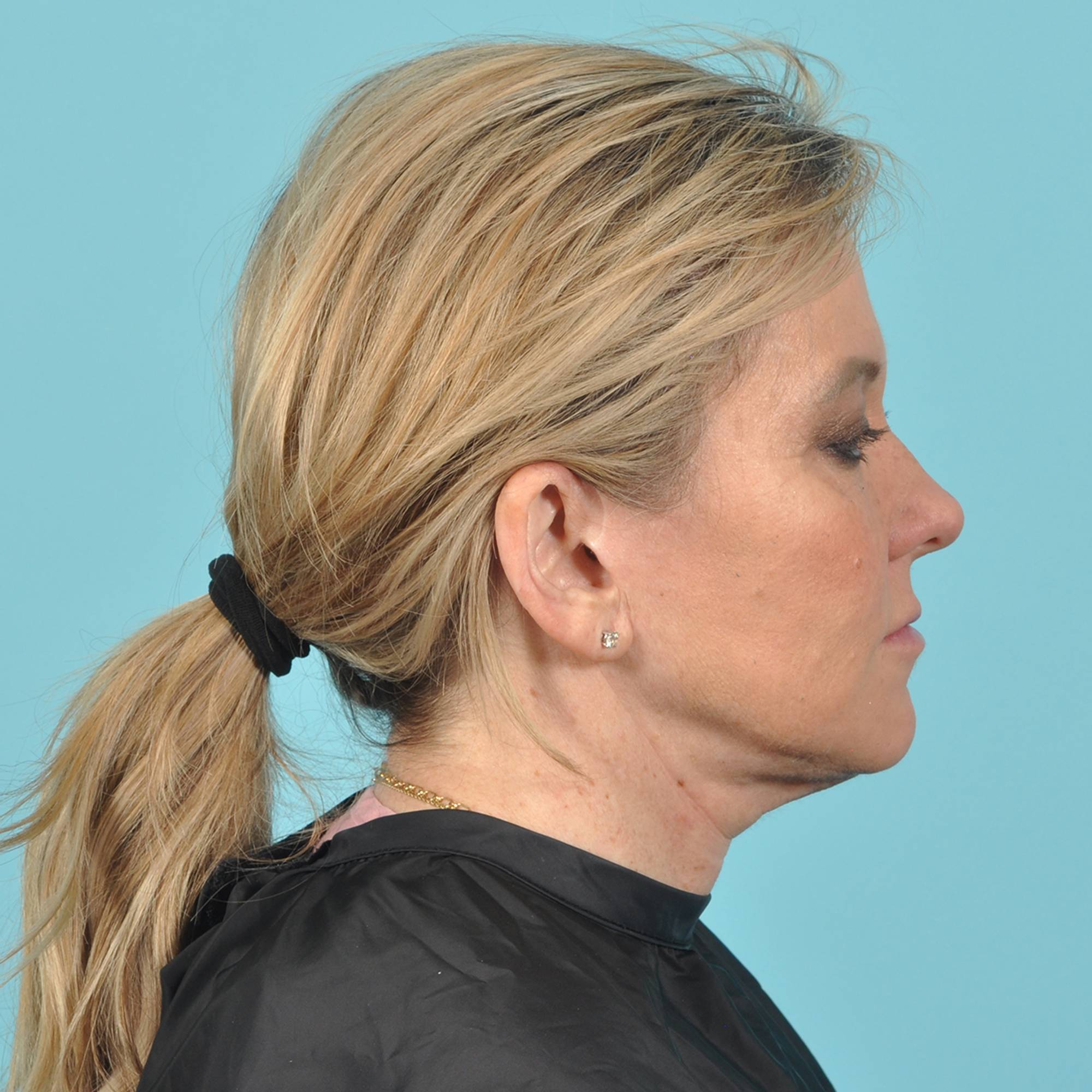 Blepharoplasty Before & After Image