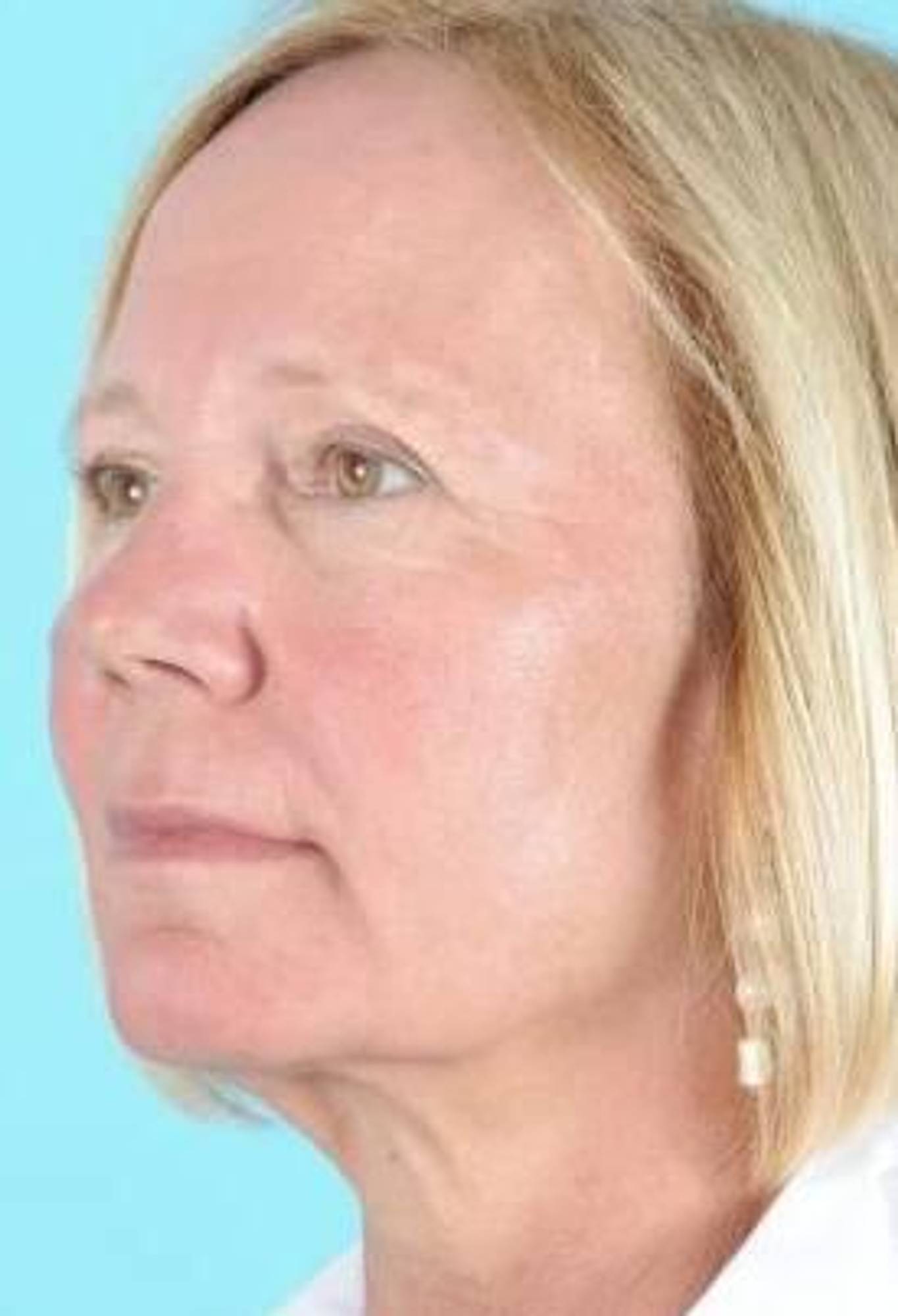 Blepharoplasty Before & After Image