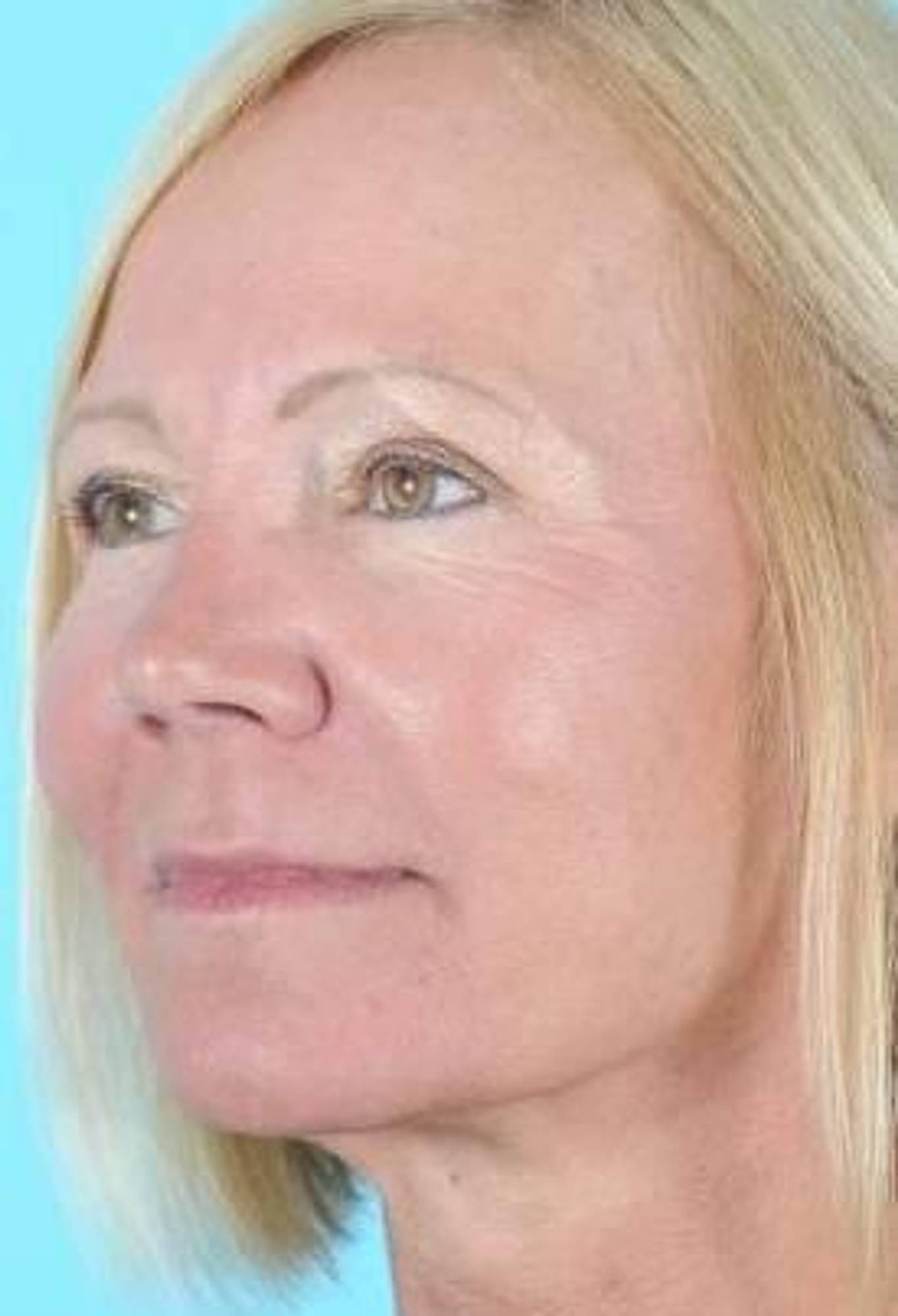 Blepharoplasty Before & After Image
