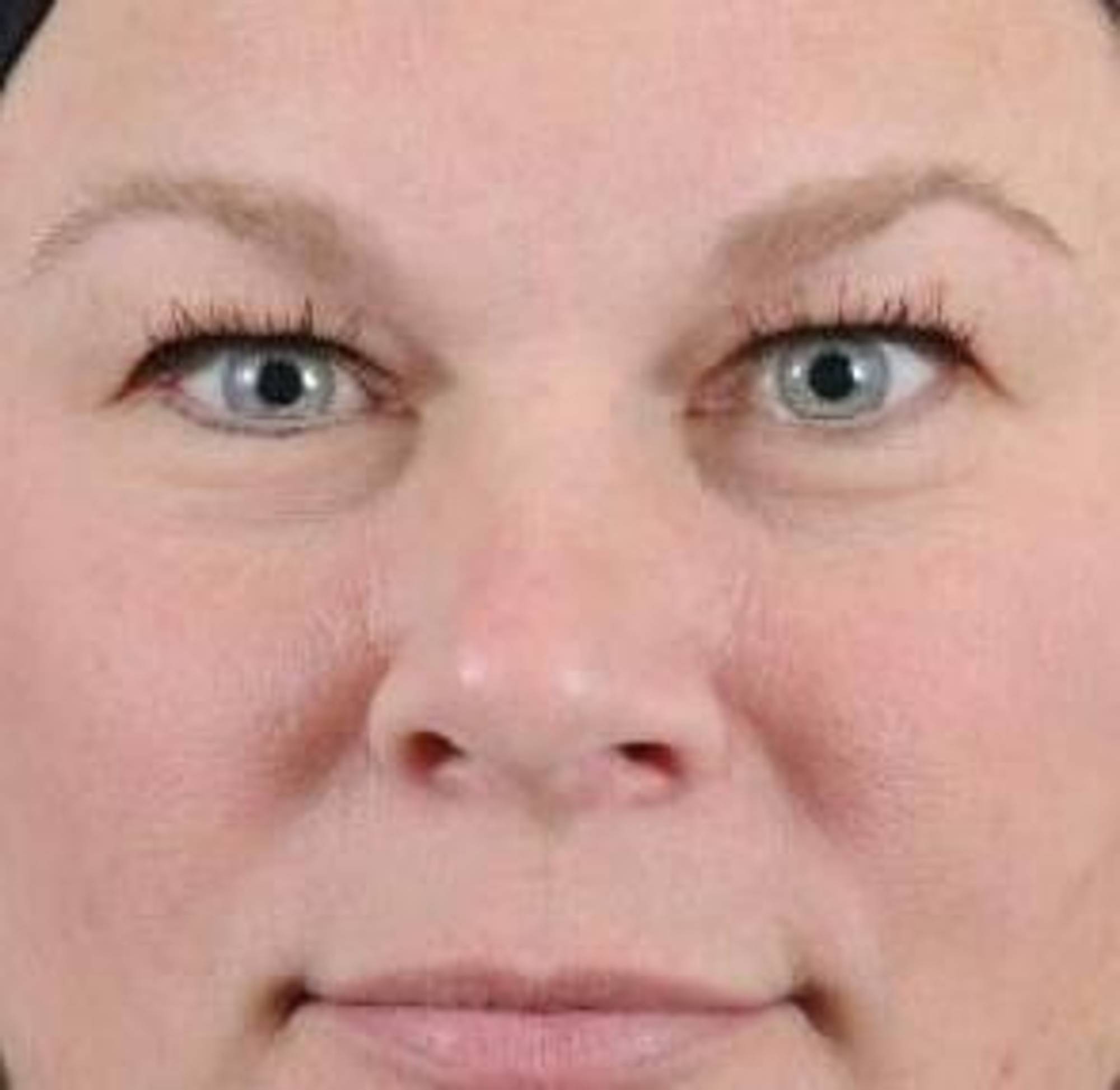 Blepharoplasty Before & After Image
