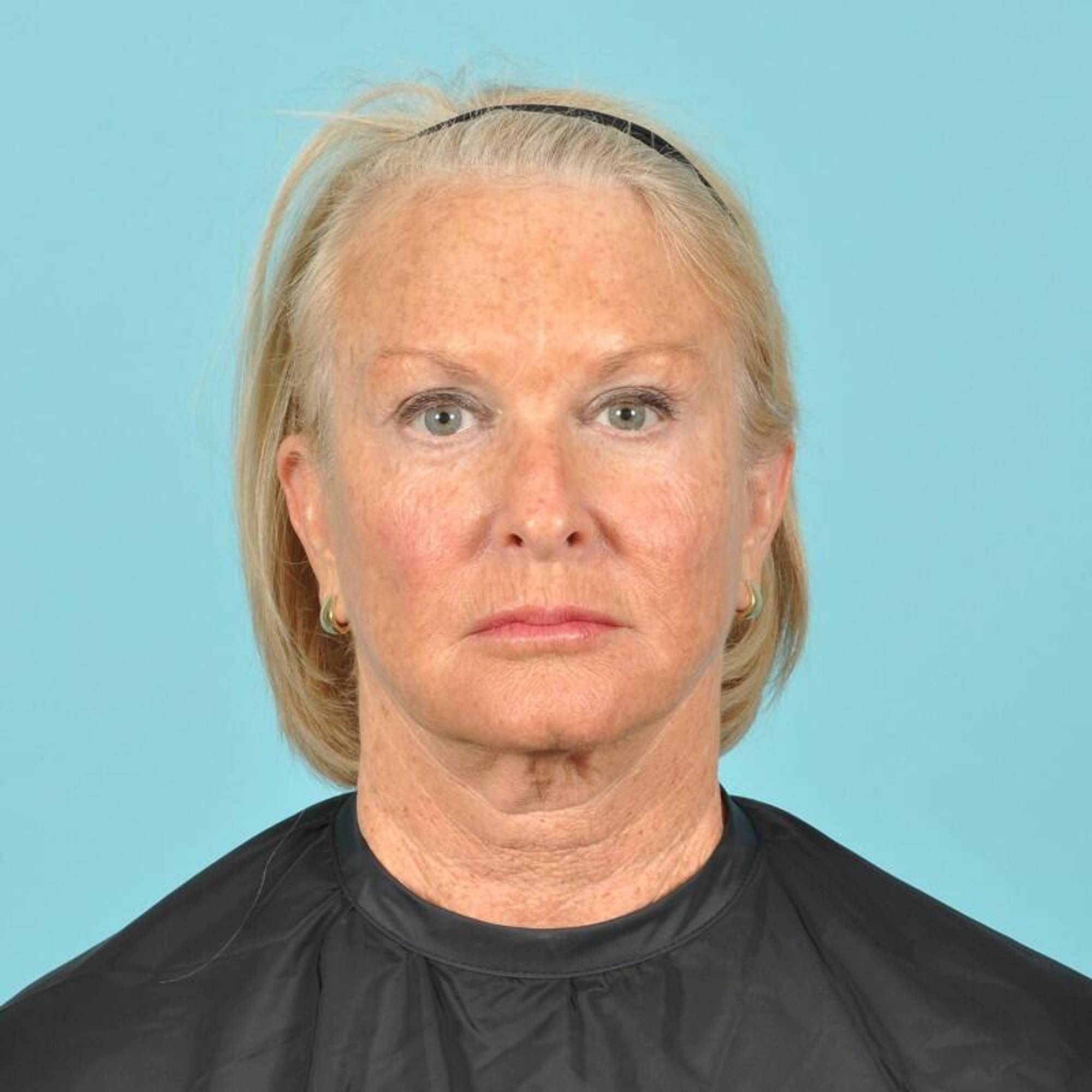 Blepharoplasty Before & After Image