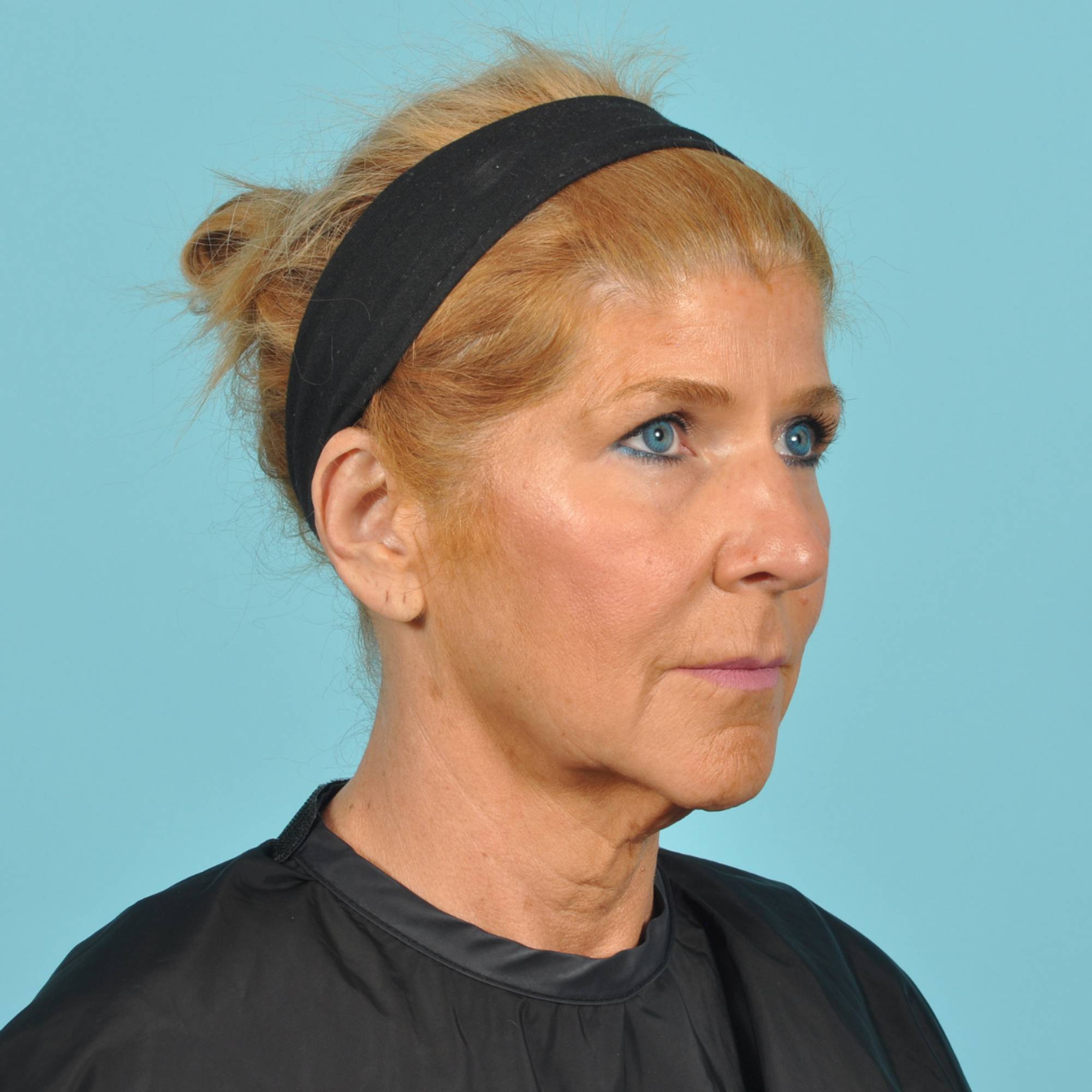 Blepharoplasty Before & After Image
