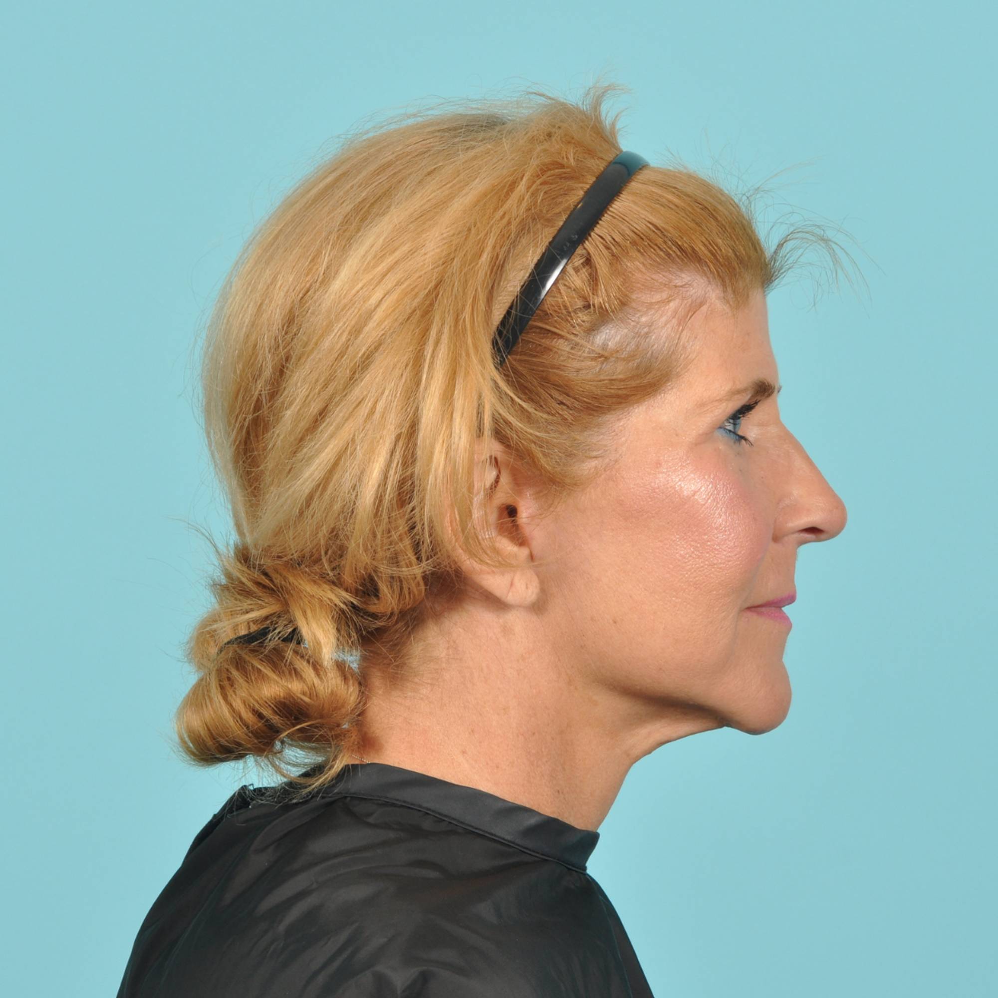 Blepharoplasty Before & After Image