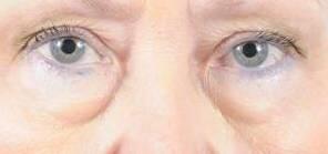 Eyelid Surgery Before & After Image Patient 31001