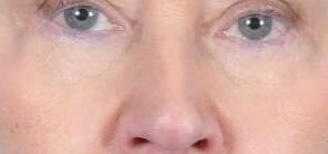 Eyelid Surgery Before & After Image Patient 31001