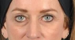 Eyelid Surgery Before & After Image Patient 31003