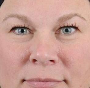 Eyelid Surgery Before & After Image Patient 31005