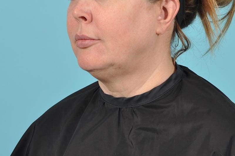 Facelift Before & After Image Patient 21670