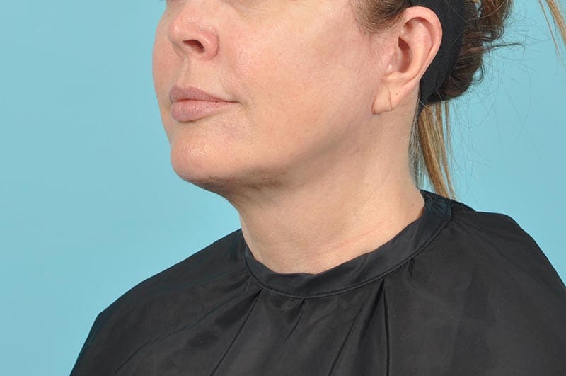 Facelift Before & After Image Patient 21670