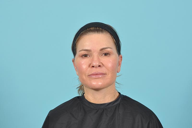 Facelift Before & After Image Patient 22292