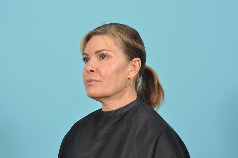 Facelift Before & After Image Patient 22292