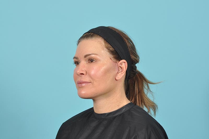 Facelift Before & After Image