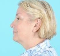 Facelift Before & After Image Patient 31500