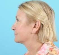 Facelift Before & After Image Patient 31500