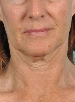 Facelift Before & After Image