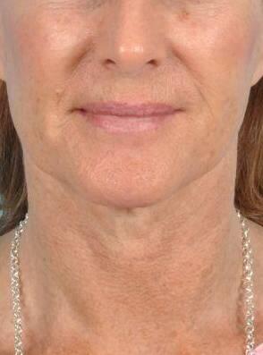 Facelift Before & After Image