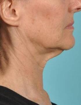 Facelift Before & After Image Patient 31502