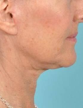 Facelift Before & After Image