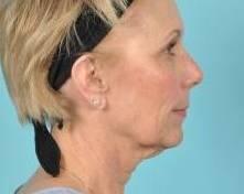 Facelift Before & After Image Patient 31503