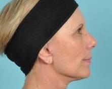 Facelift Before & After Image Patient 31503