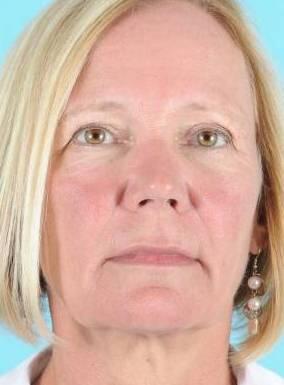 Facelift Before & After Image