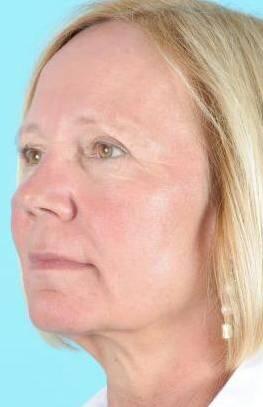 Facelift Before & After Image