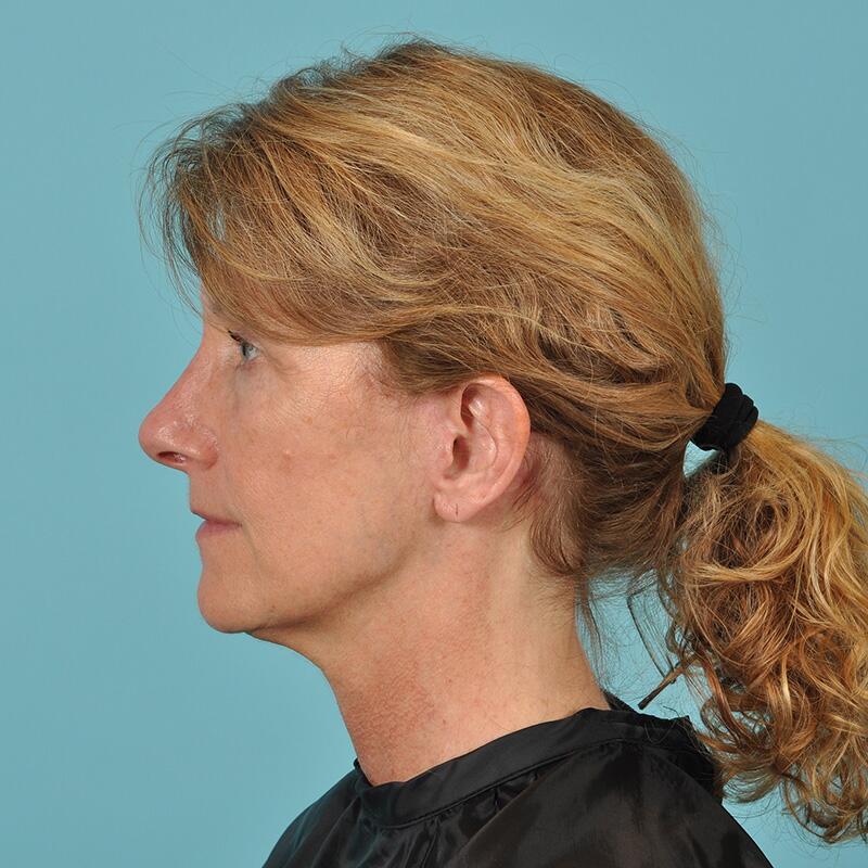 Facelift Before & After Image Patient 31506