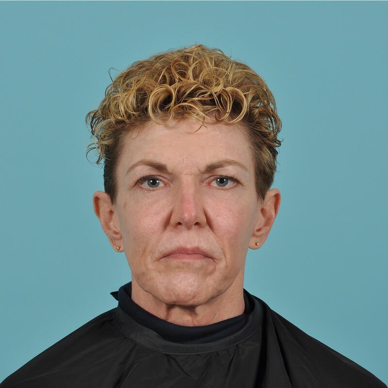 Facelift Before & After Image Patient 31508