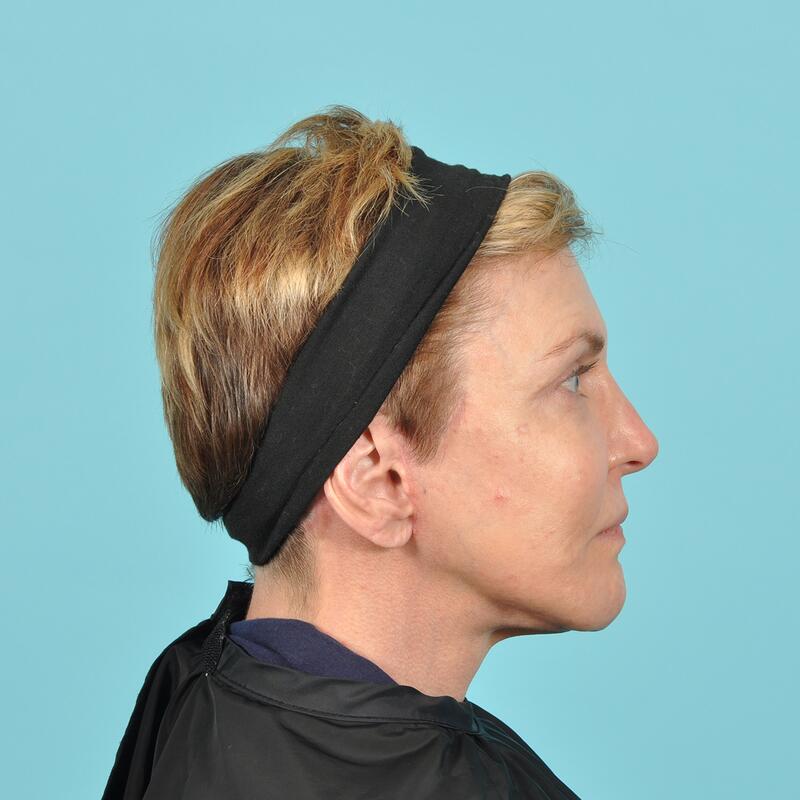 Facelift Before & After Image Patient 31508