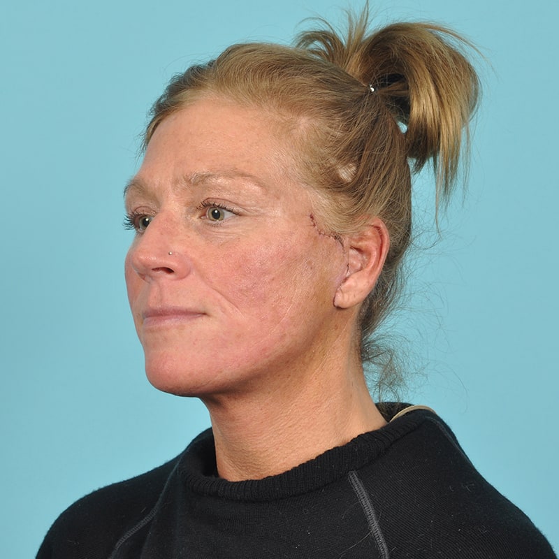 Facelift Before & After Image Patient 33216