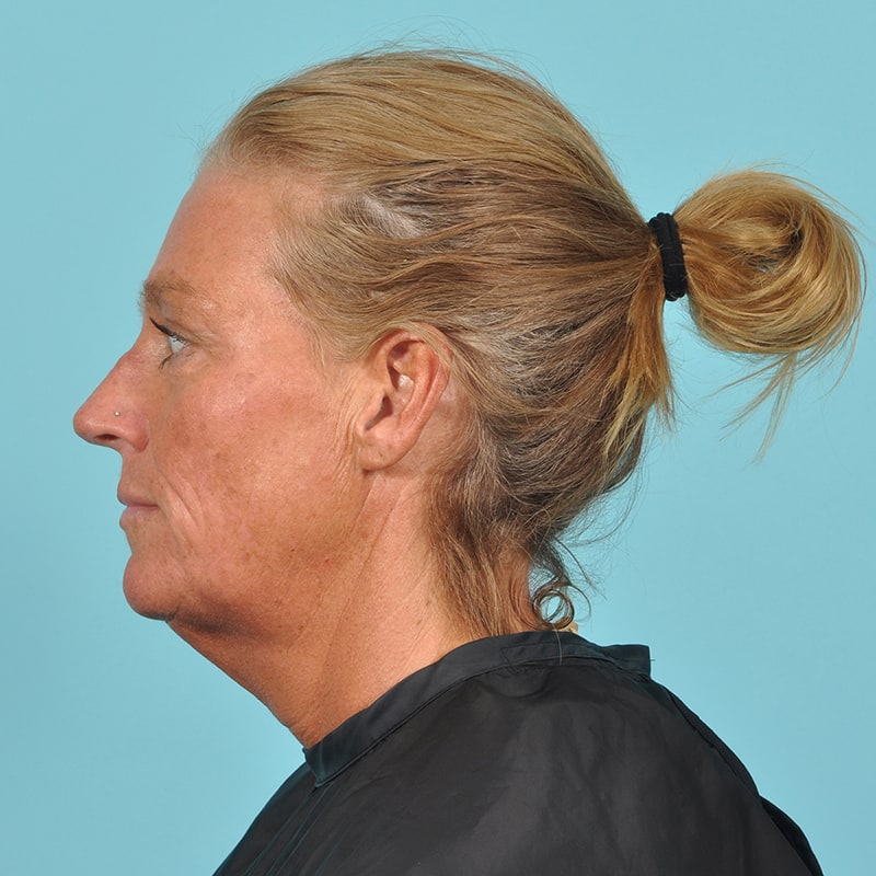 Facelift Before & After Image Patient 33216