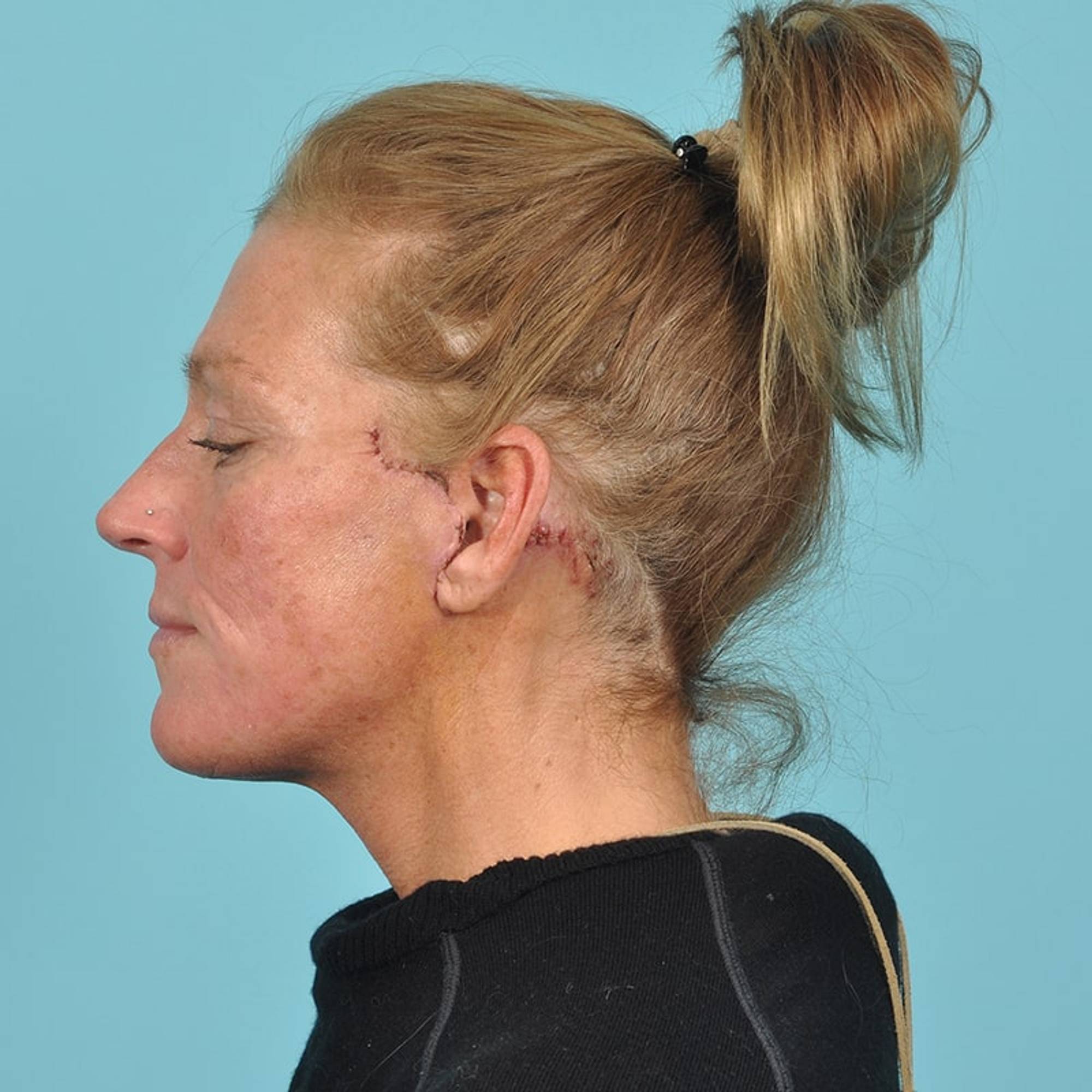 Facelift Before & After Image Patient 33216