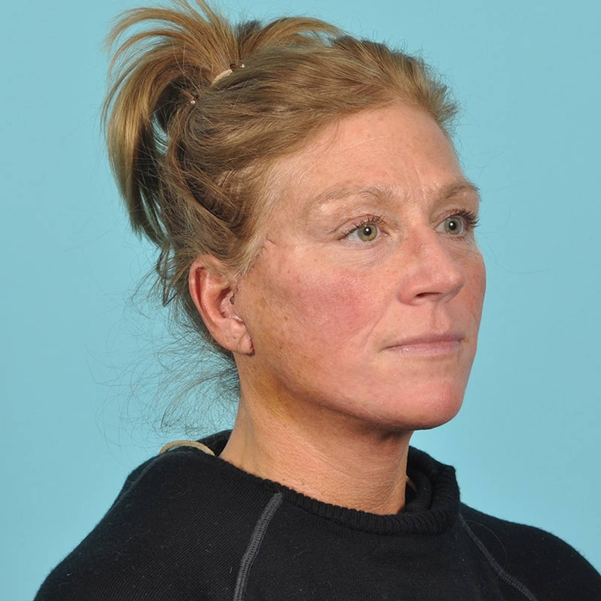 Facelift Before & After Image Patient 33216