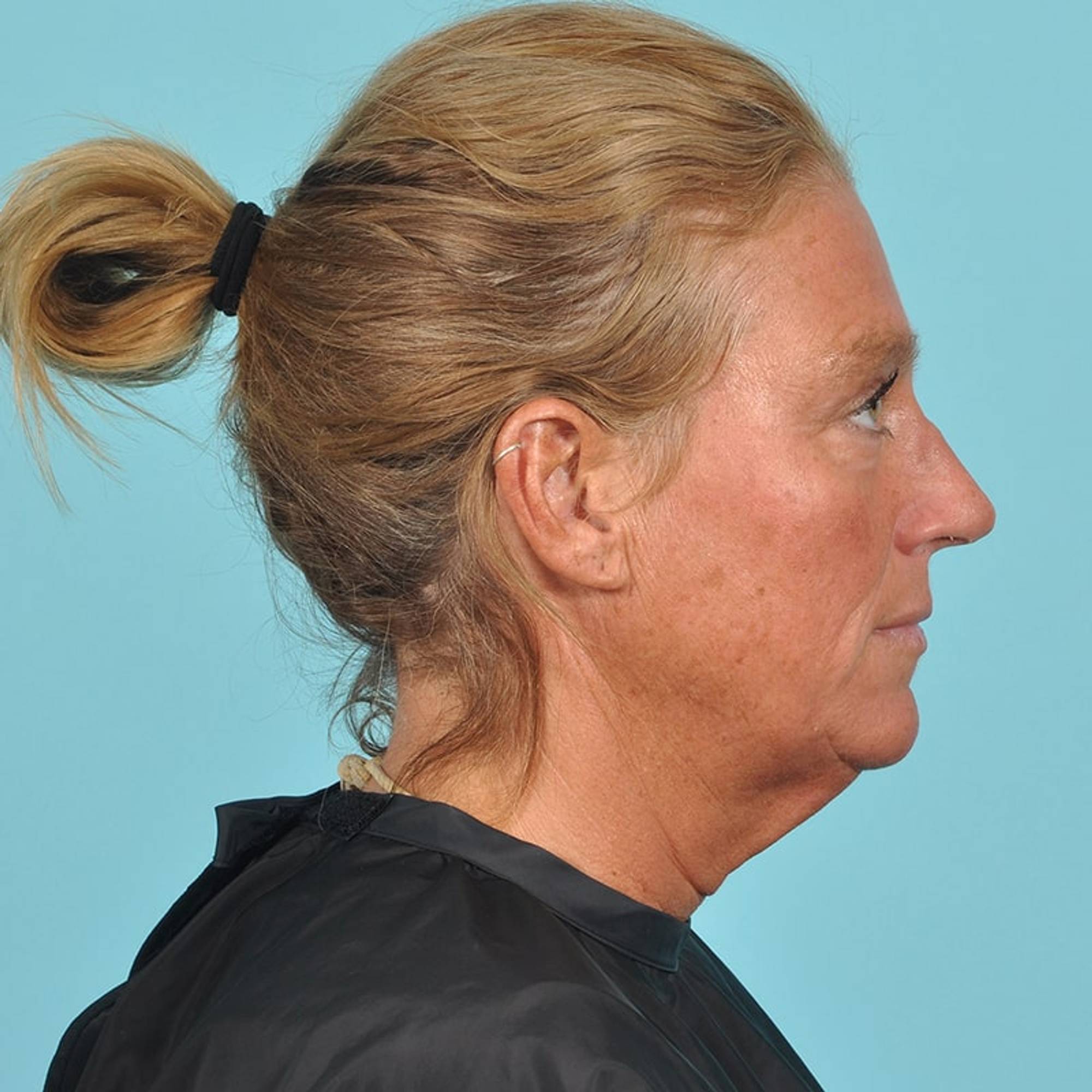 Facelift Before & After Image Patient 33216