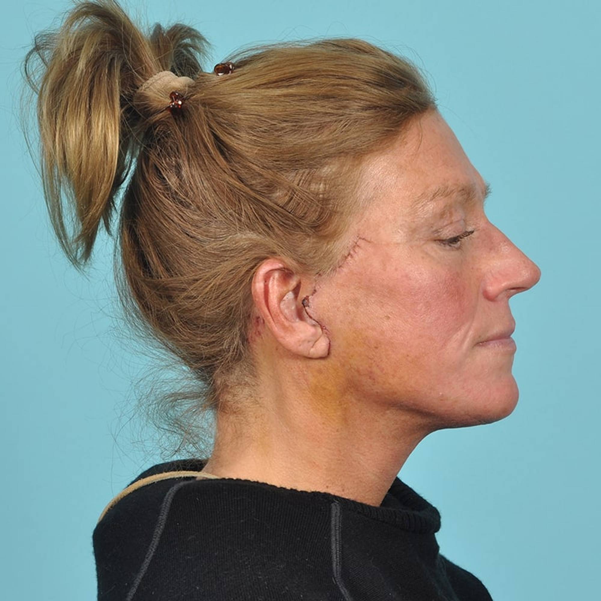 Facelift Before & After Image Patient 33216