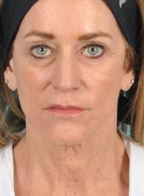 Facial Fat Grafting Before & After Image Patient 31600