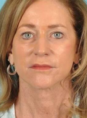Facial Fat Grafting Before & After Image