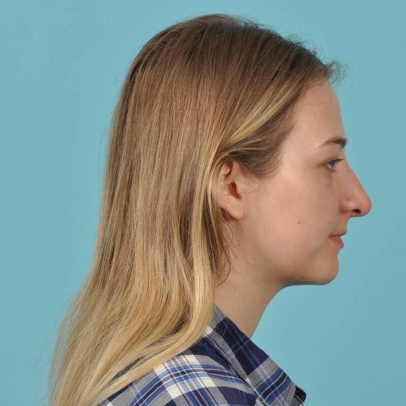 Rhinoplasty Before & After Image