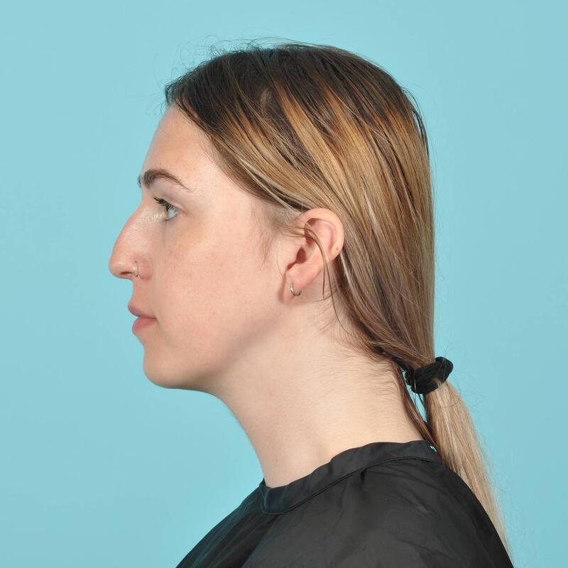 Rhinoplasty Before & After Image