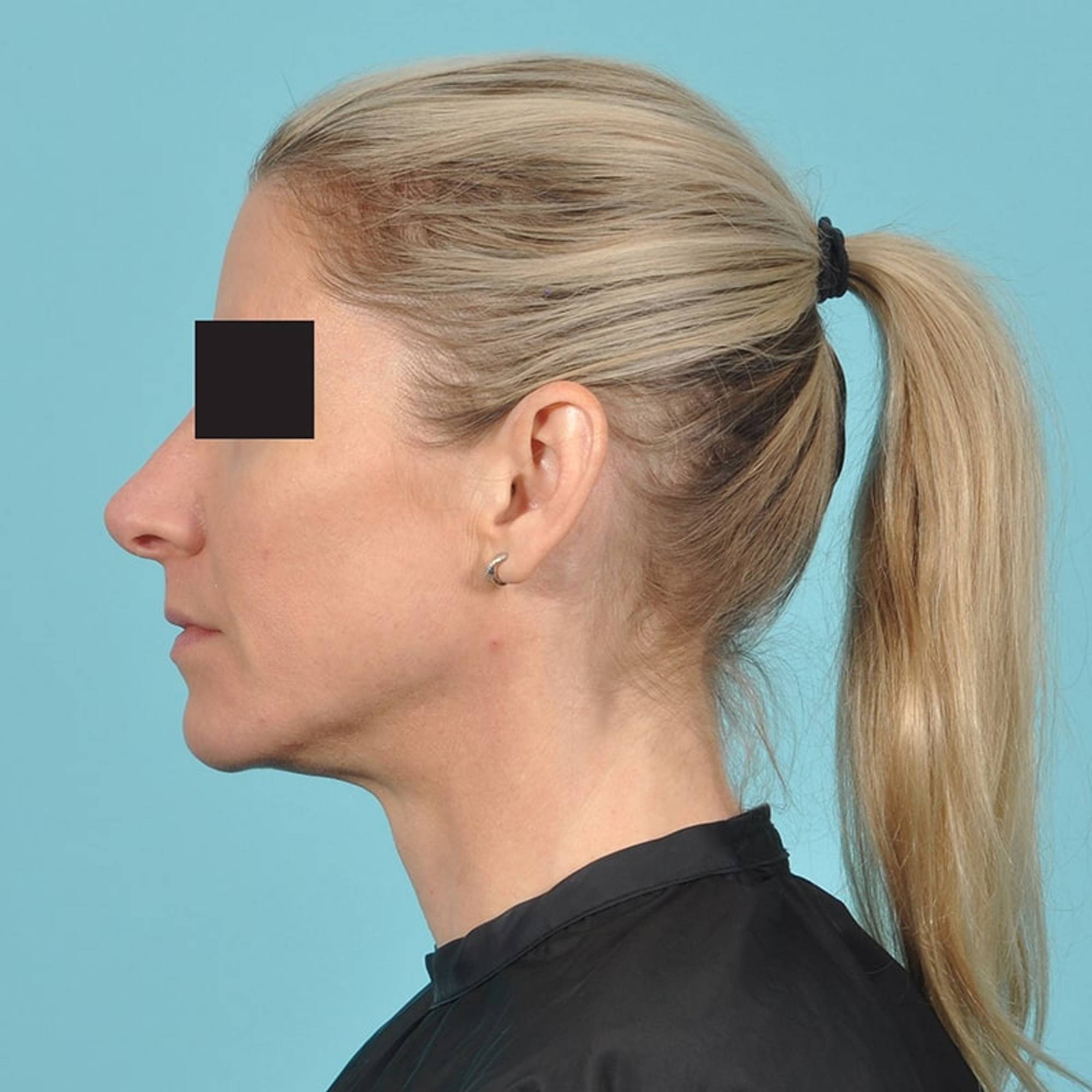 Rhinoplasty Before & After Image Patient 33301