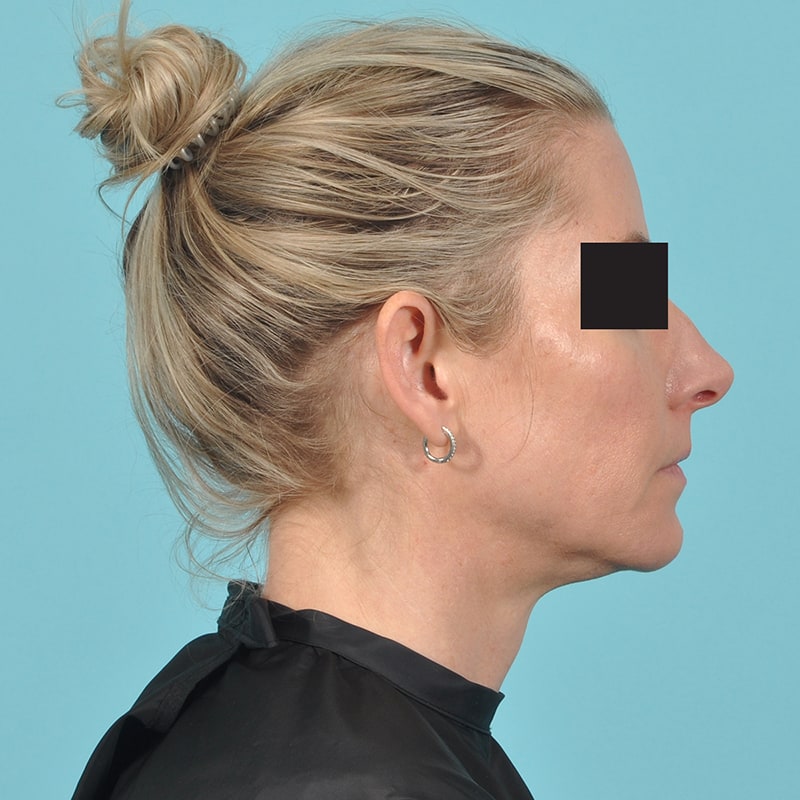 Rhinoplasty Before & After Image Patient 33301