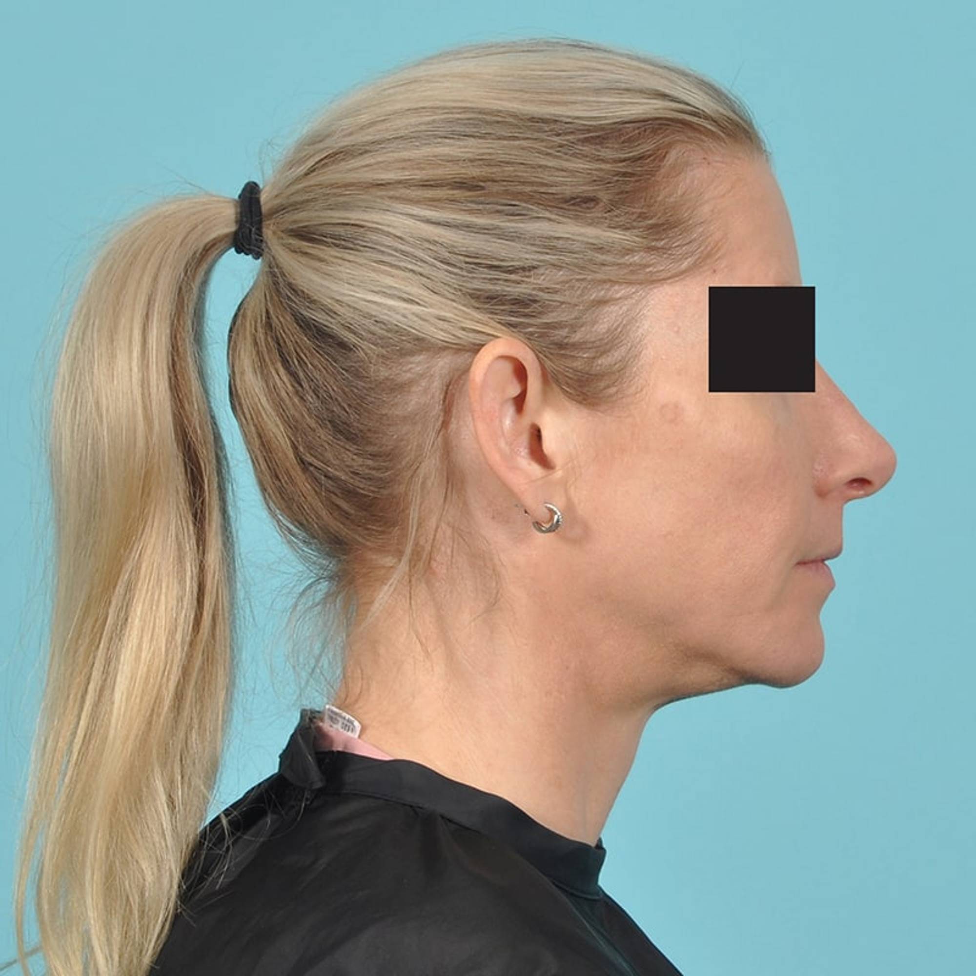 Rhinoplasty Before & After Image